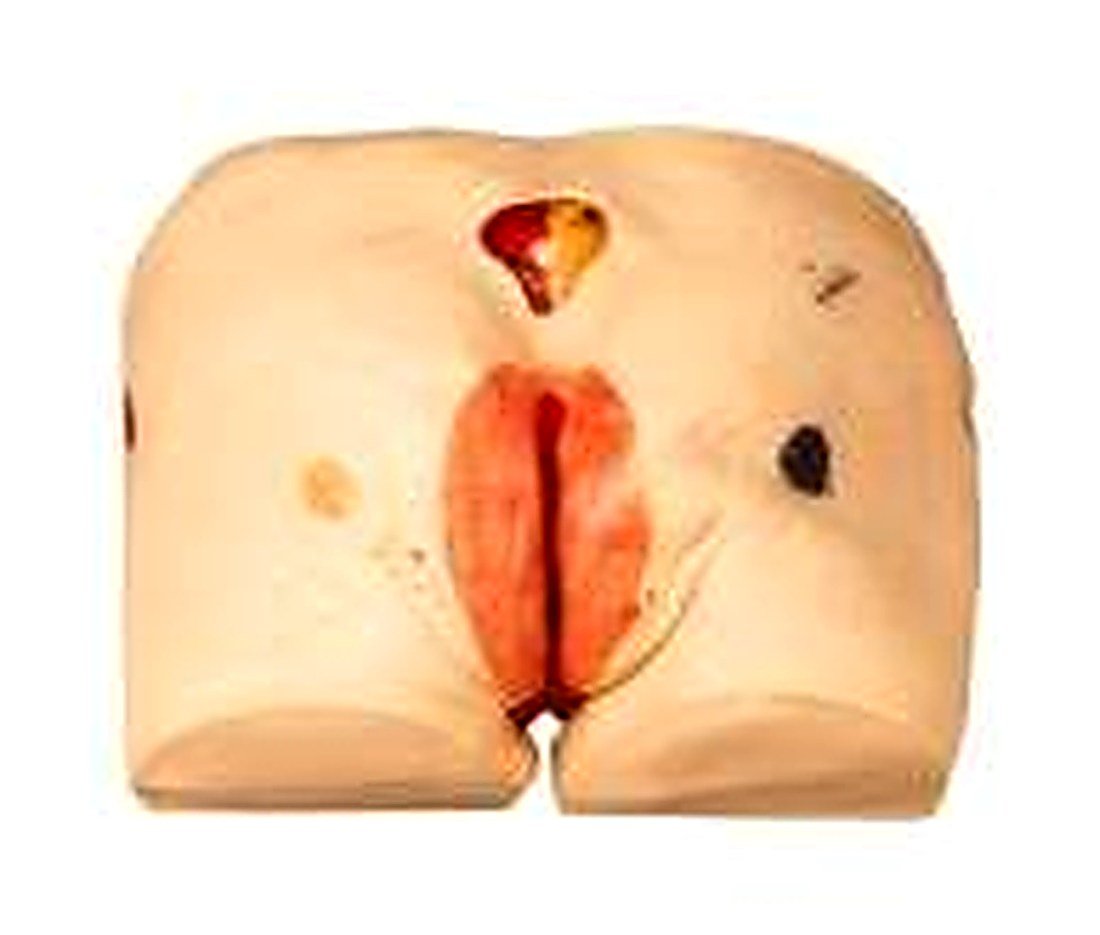 Decubitus Ulcer Care Simulator — product photograph | VistaStay Med