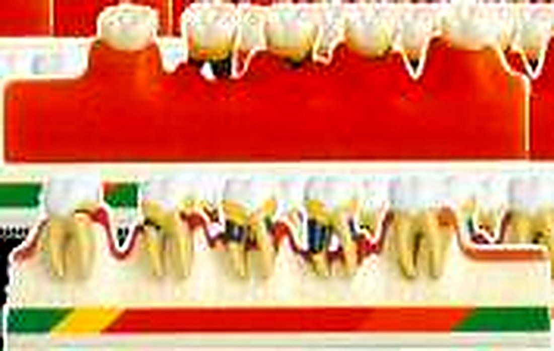 PERIODONTAL DISEASE MODEL - The model — product photograph | VistaStay Med