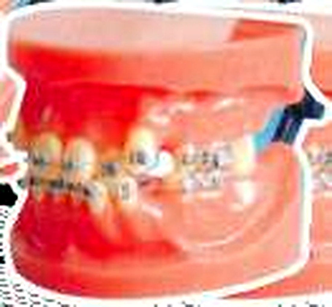 Fixed Orthodontic Model (Dislocation) — product photograph | VistaStay Med