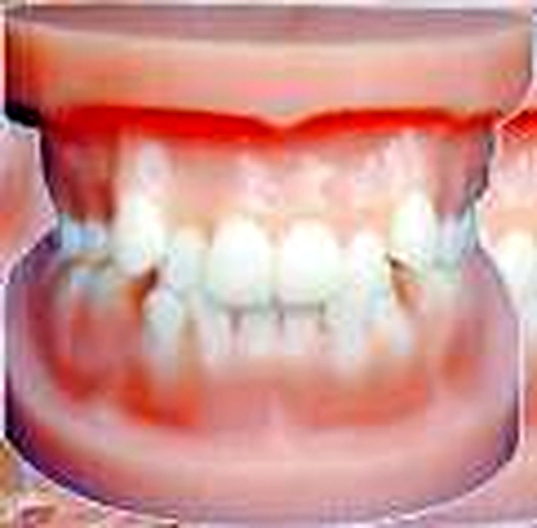 ORTHODONTIC MODEL - Shows the abnormal structure of crowded teeth, anti-jaw, protrusion, jaw opening, etc — product photograph | VistaStay Med