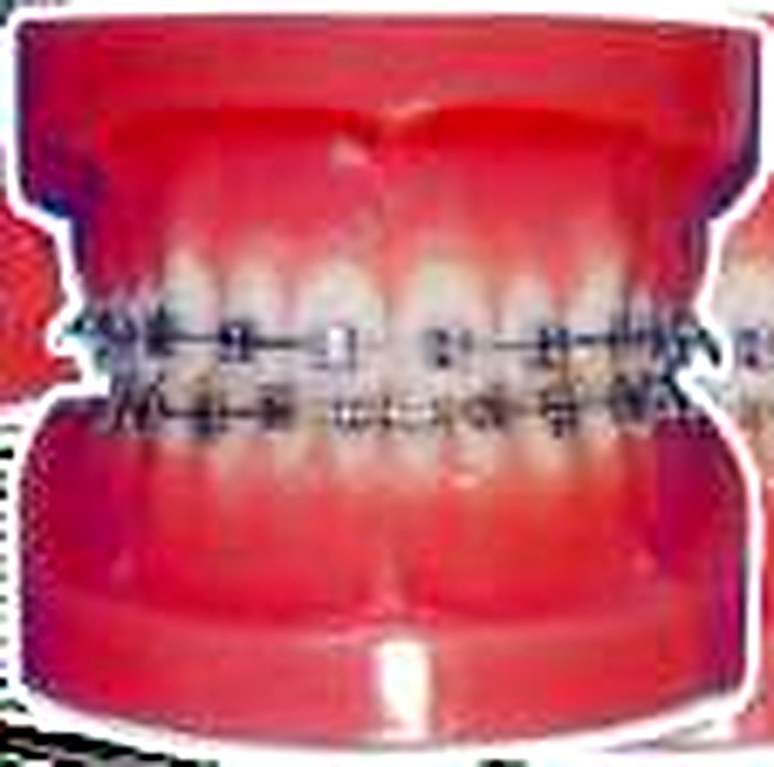 Fixed Orthodontic Model (Normal) — product photograph | VistaStay Med