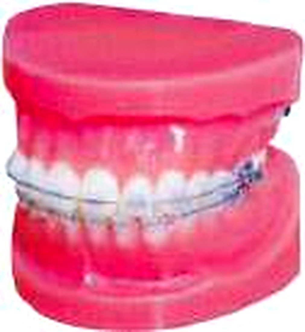 Fixed Orthodontic Model (Normal) — detail view | VistaStay Med