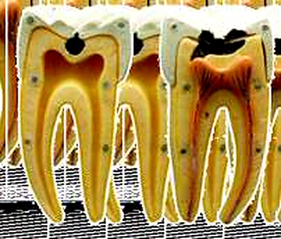 DENTAL CARIES MODEL - The model shows dental caries in initial and advanced stages. 16 positions are displayed. size 39x39x26 cms — product photograph | VistaStay Med